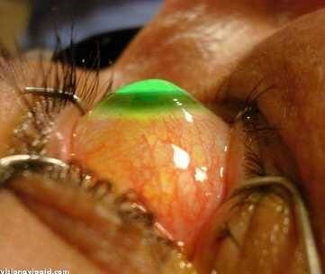 Corneal Cross-Linking Procedure