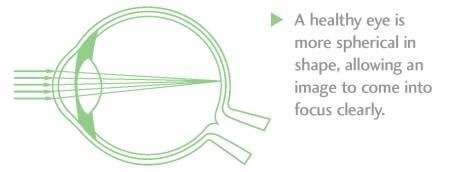 Keratoconus Image 1
