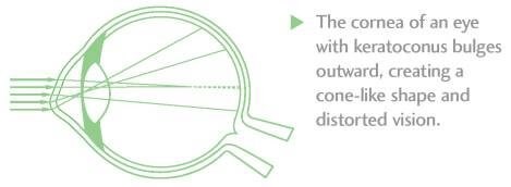 Keratoconus Image 2