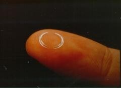Keratoconus Image 1