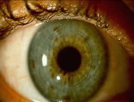Keratoconus Image 1