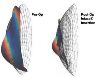 Keratoconus Image 1