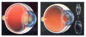 cataract side by side