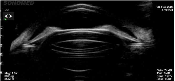 Oversized ICL – note anterior displacement of the iris